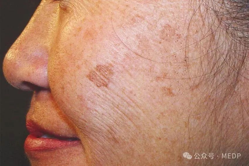 老年斑、晒斑、日光性雀斑是一回事吗？